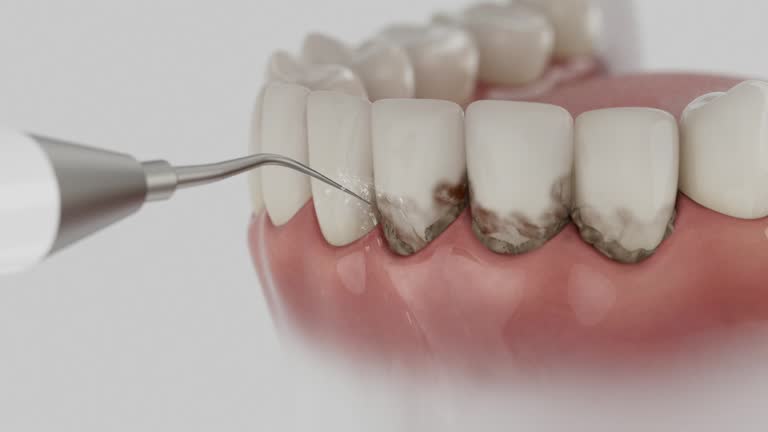 Trusted Dental Crowns And Bridges service in Iona, FL - Dentist Open Now